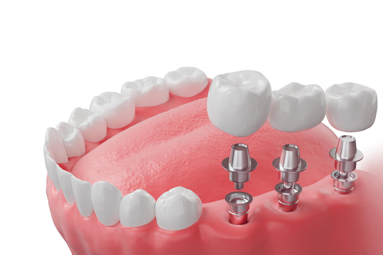 Implant-supported dental bridge replacing multiple missing teeth at Fusion Dental Implants Sacramento and Roseville CA